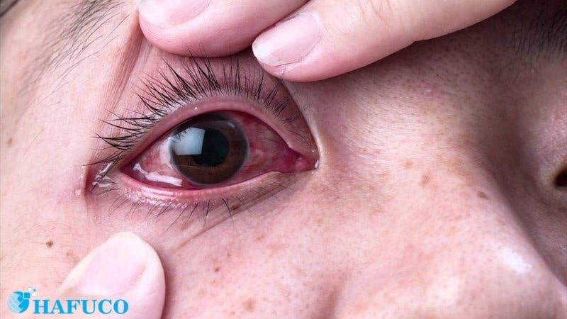 Các triệu chứng bệnh đau mắt đỏ do bơi